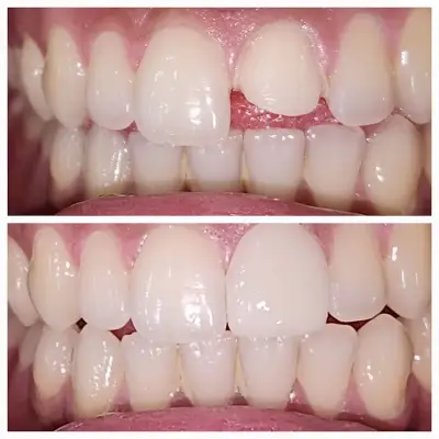 Smile result (before / after)