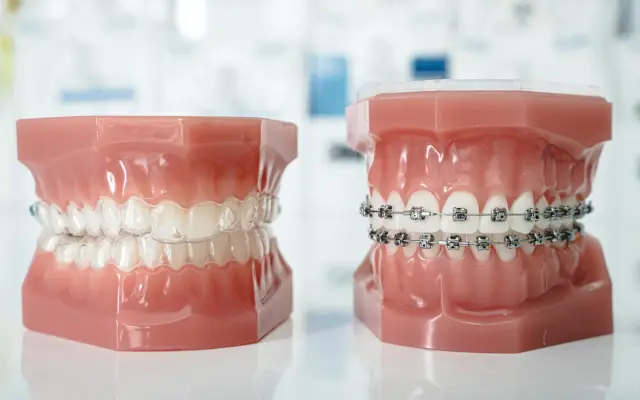 Dental models comparing a clear aligner with metal braces