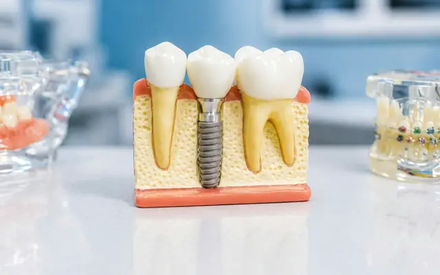 Dental implant model showing a titanium implant and crown between natural teeth